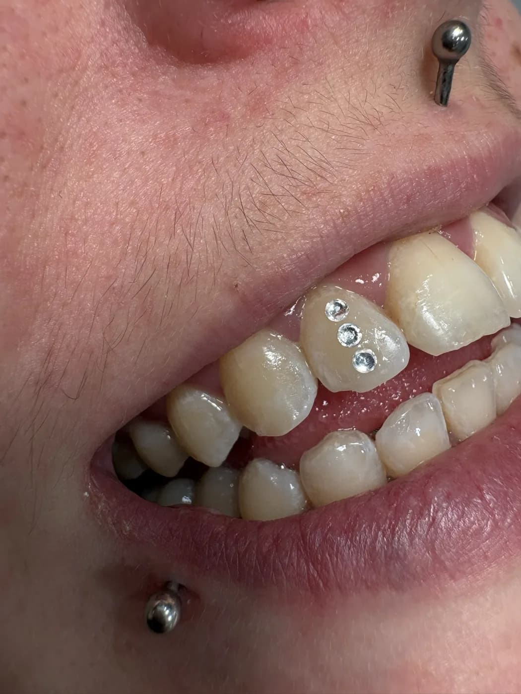 Trois strass cristal alignés sur une prémolaire