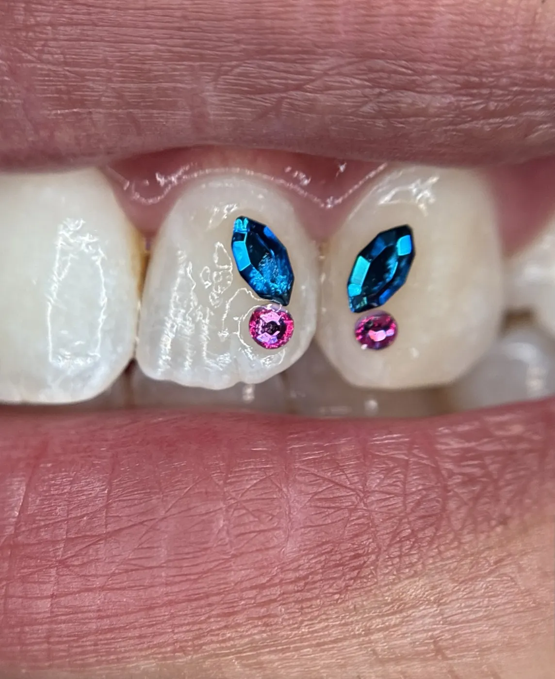 Papillon en gemmes bleues et roses sur les incisives centrales
