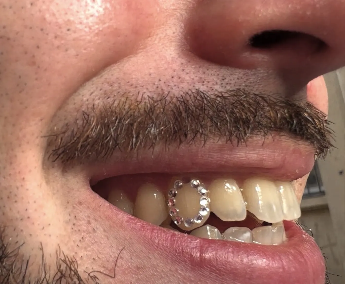 Contour d'une dent entièrement souligné en strass