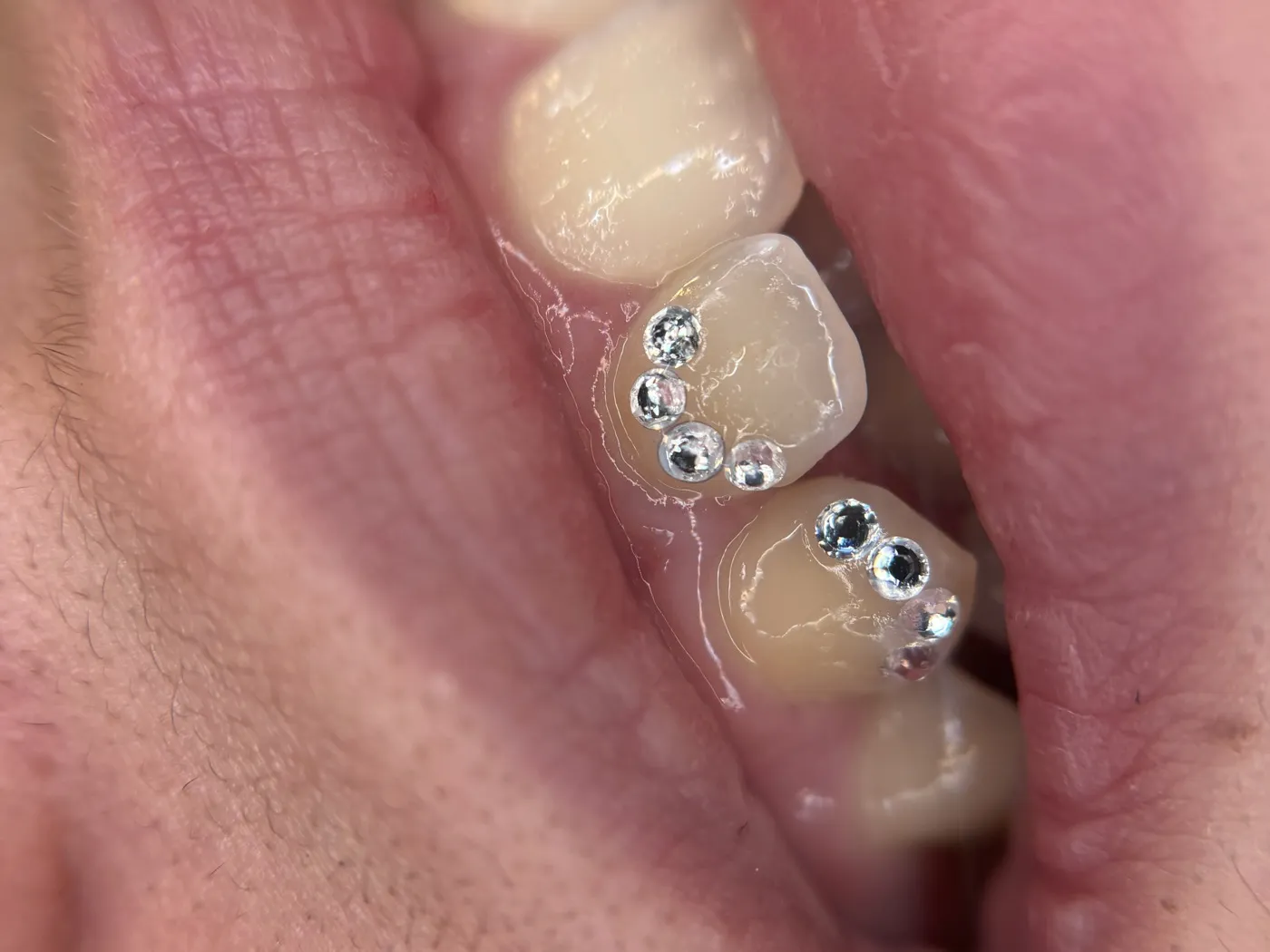 Vague de strass déroulée sur deux dents